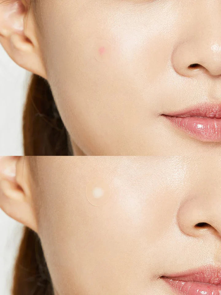 Cosrx Acne Pimple Master Patch - Koreancare