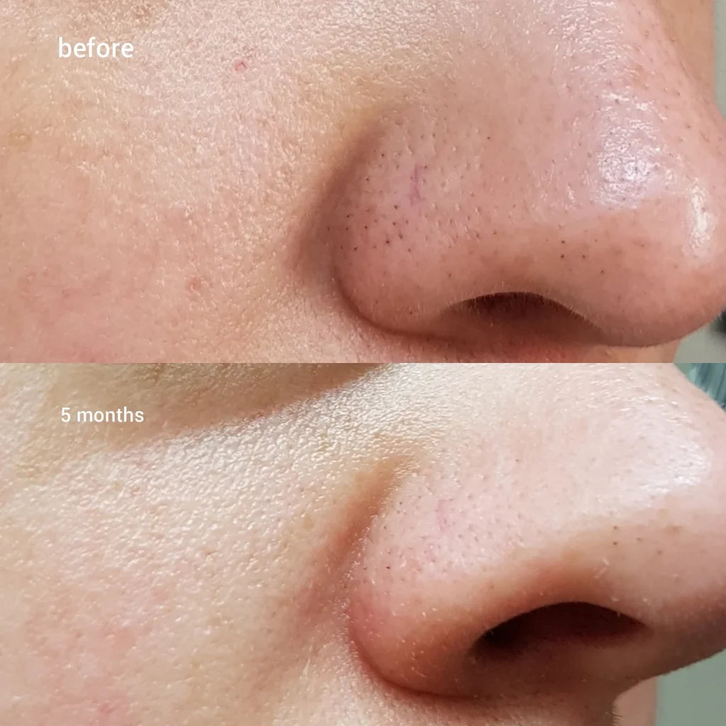 COSRX BHA Blackhead Power Liquid Exfoliating Essence - Koreancare