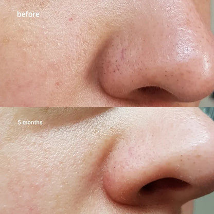 COSRX BHA Blackhead Power Liquid Exfoliating Essence - Koreancare