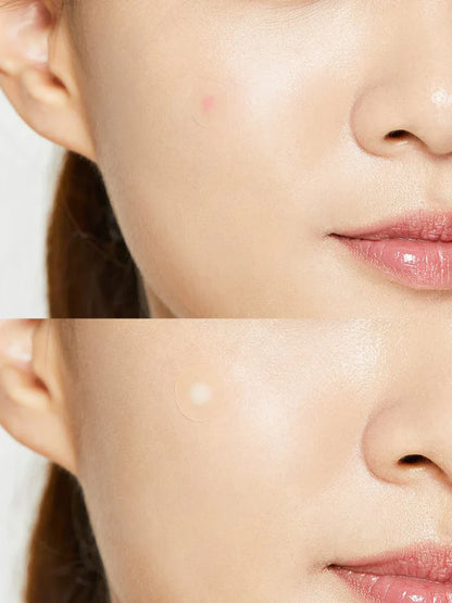Cosrx Acne Pimple Master Patch - Koreancare